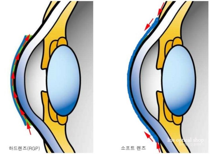 소프트렌즈와 하드렌즈의 비교