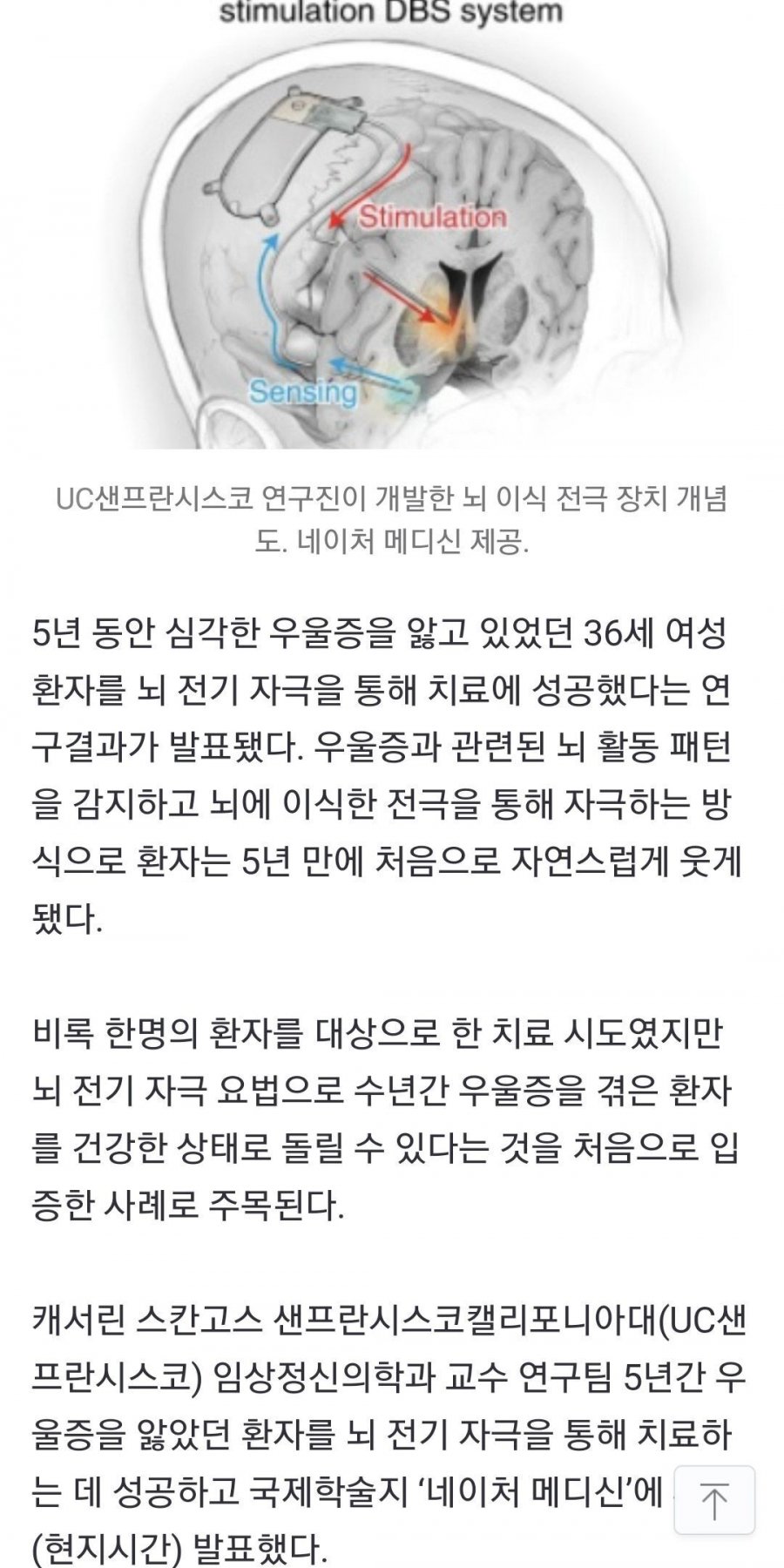 뇌에 전기충격을 가하면